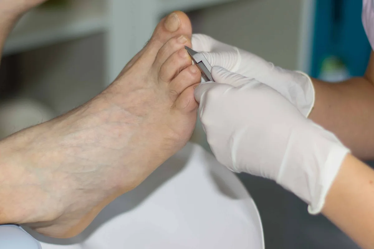 Soin de coupe d'ongle réalisé par Bénédicte Vidot au cabinet